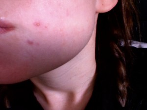 Giant Whitehead Pimple